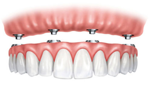 Implants dentaires pour appareil