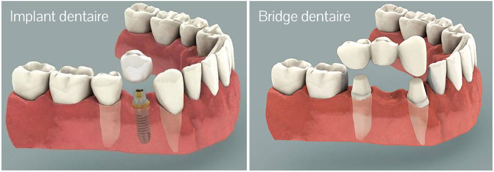 Différence implant / bridge